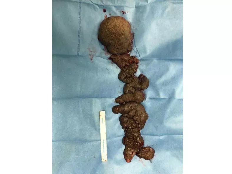 切除巨大瘤体的 9h「换脸」手术,和背后优秀的整形外科医生 切除巨大瘤体的 9h「换脸」手术,和背后优秀的整形外科医生
