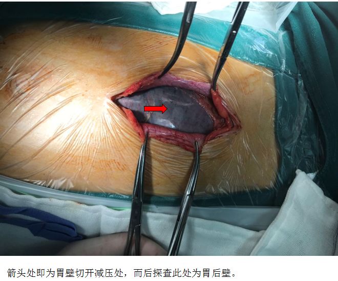 从膈下到盆腔，你见过这么严重的胃扩张吗？