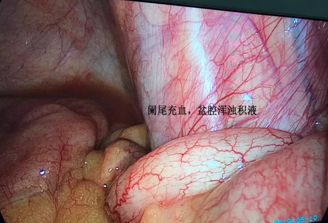 这种病几乎 100% 误诊为阑尾炎，你能否准确识别？