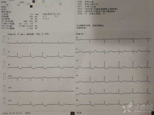 患者口服 300 片地高辛，全程心电图如何演变？
