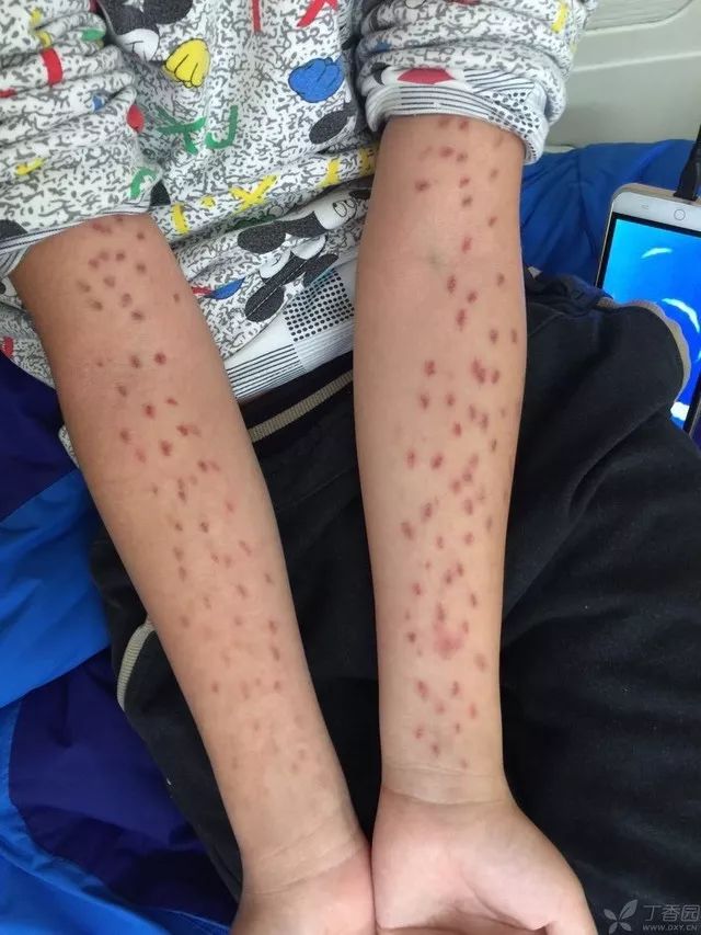 看图识病 | 如此密集对称的双上肢瘀斑，难不成是自残？