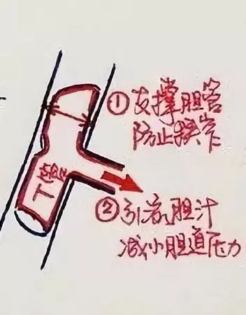 还在死磕胆结石手术操作？手绘图教你一秒看明白