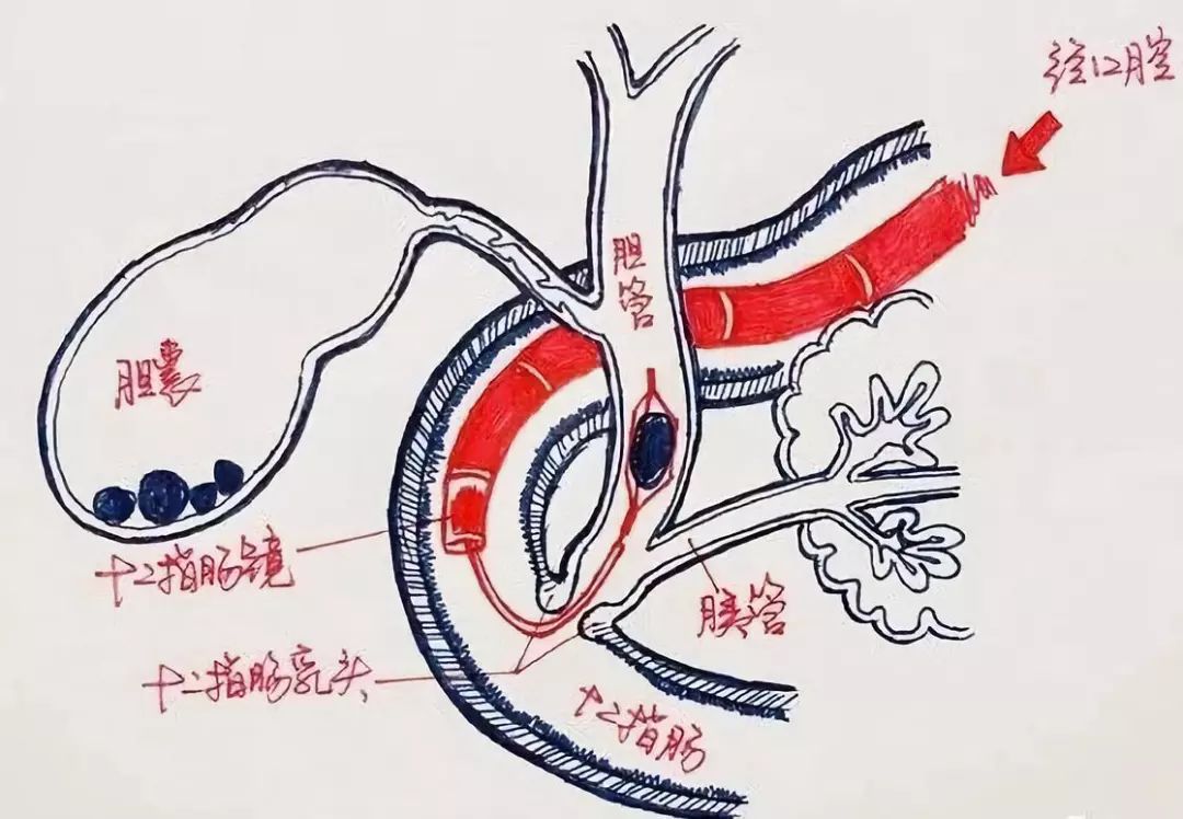 还在死磕胆结石手术操作？手绘图教你一秒看明白