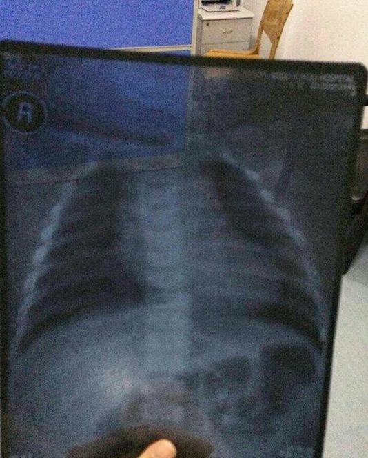 丁香病例 | 4 个月女婴入院到死亡仅半小时，何因？