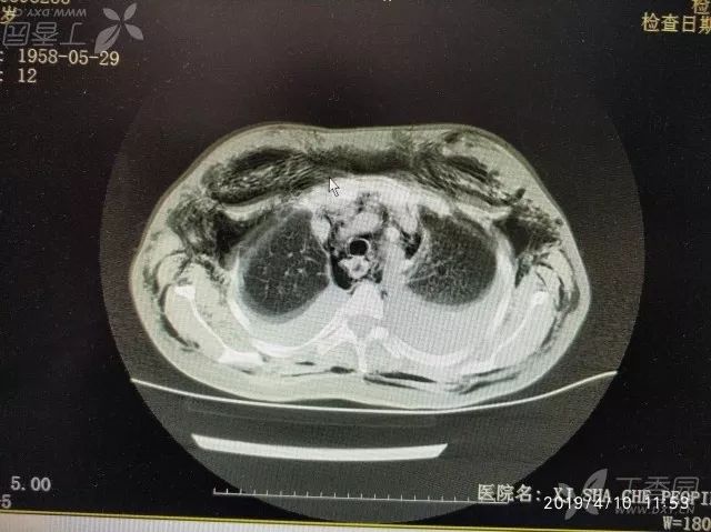 丁香病例 | 难得一见的「充气人」,查完 CT 后死亡 丁香病例 | 难得一见的「充气人」,查完 CT 后死亡