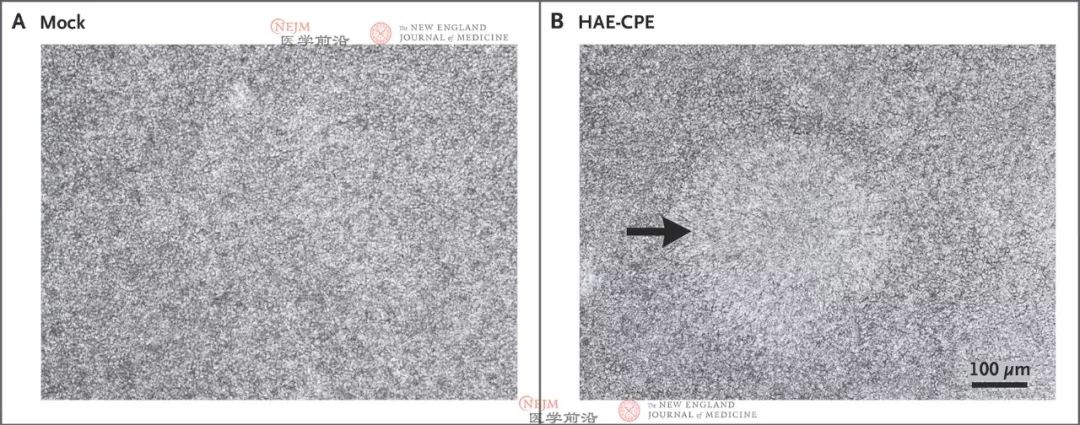 重要数据 | 中国团队在 NEJM 发布新型冠状病毒研究 重要数据 | 中国团队在 NEJM 发布新型冠状病毒研究