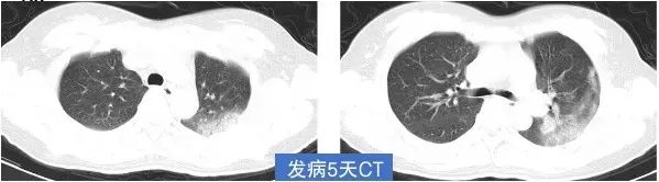 4 次核酸阴性后 CT 确诊，新冠肺炎 CT 表现 5 个特点请牢记