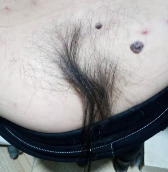 丁香病例 | 35 岁男性，后腰骶部「长发飘飘」，这是什么病？