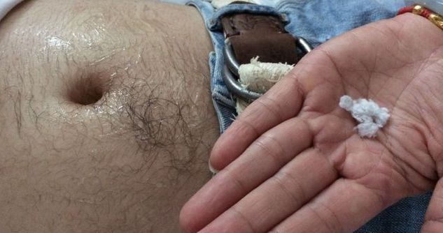 丁香病例 | 患者肚脐「自产棉花」，啥情况？