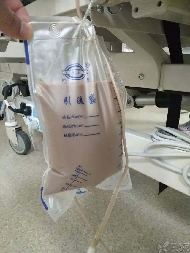 丁香病例 | 酷似「奶茶」的胸腔积液，是什么原因？