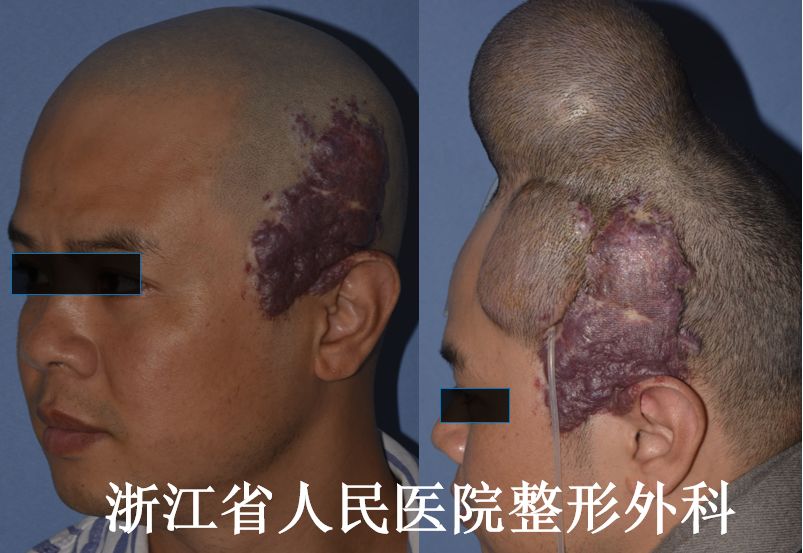 血管瘤：听说最近流行分享病例？这里管够