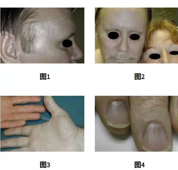 号称能返老还童的保健品，却让他全身变蓝，最终死去