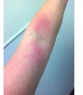 5 类常见儿童荨麻疹，你是否都已掌握？