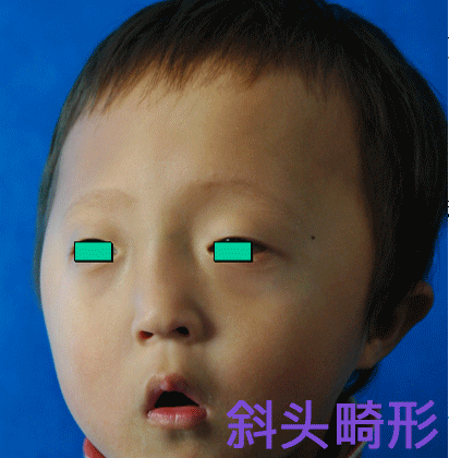 视频讲解 | 颅面畸形之眶距增宽症的治疗