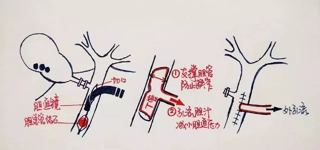 还在死磕胆结石手术操作？手绘图教你一秒看明白