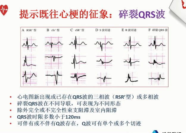 【含病例】告别死记硬背，心电图这样学习不会都难