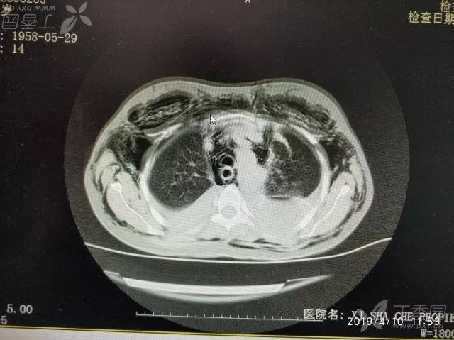 丁香病例 | 难得一见的「充气人」,查完 CT 后死亡 丁香病例 | 难得一见的「充气人」,查完 CT 后死亡