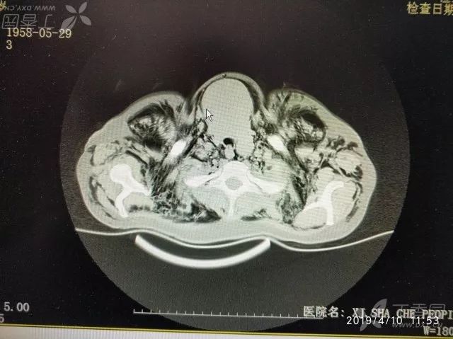 丁香病例 | 难得一见的「充气人」,查完 CT 后死亡 丁香病例 | 难得一见的「充气人」,查完 CT 后死亡