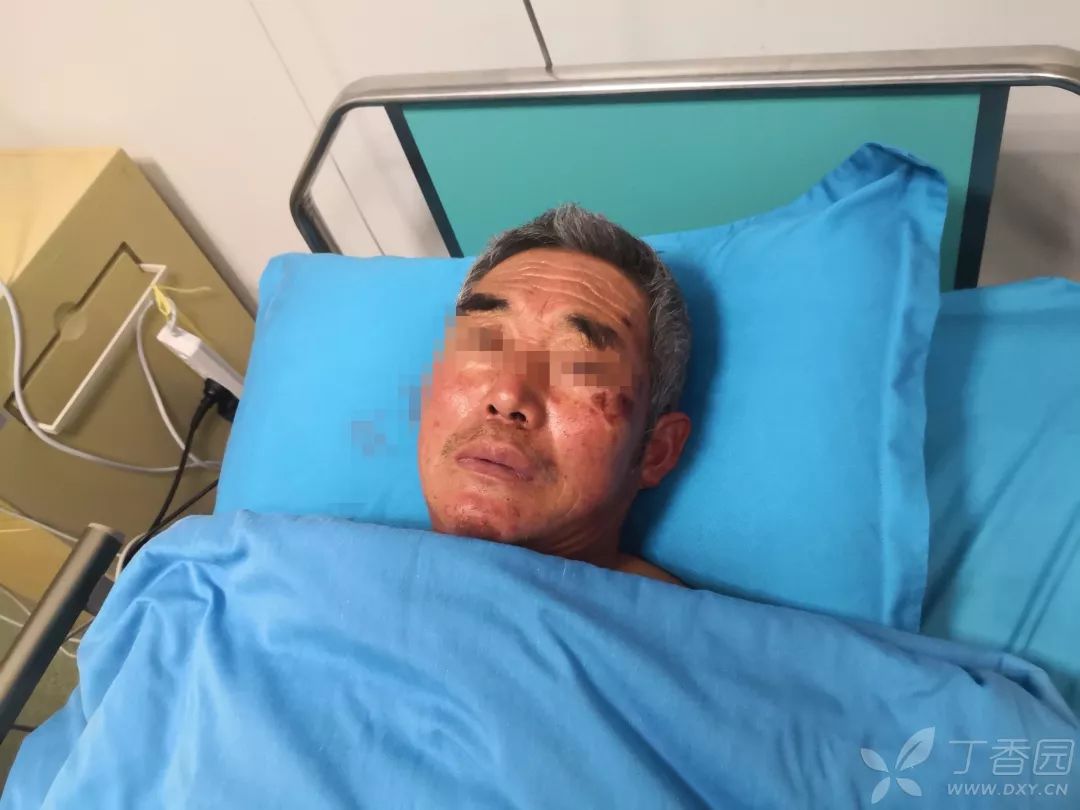 吃药后昏迷 2 小时,全身酸痛的男人! | 丁香病例 吃药后昏迷 2 小时,全身酸痛的男人! | 丁香病例