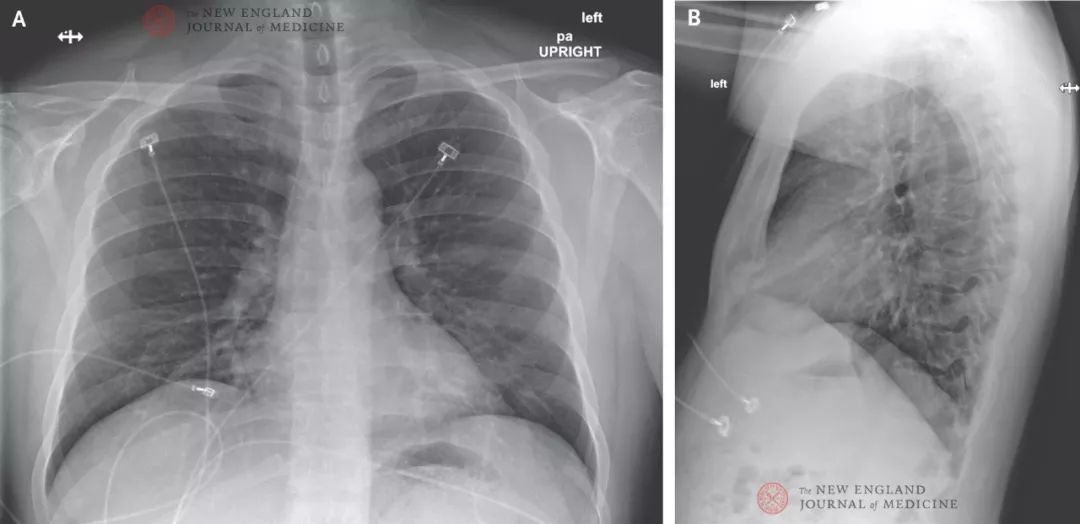 重磅！美国首例新冠病毒肺炎治疗康复全过程 | NEJM 官方翻译