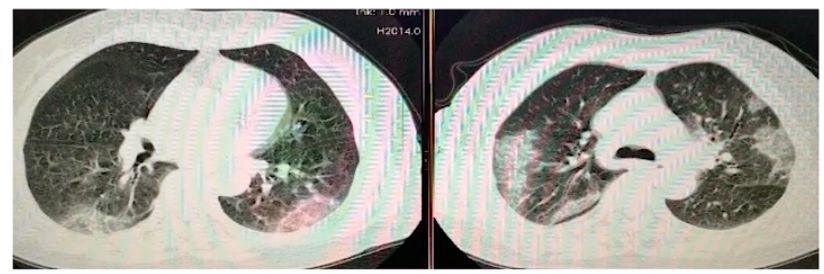 4 次核酸阴性后 CT 确诊，新冠肺炎 CT 表现 5 个特点请牢记