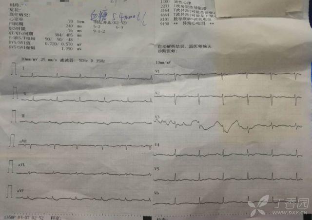 患者口服 300 片地高辛，全程心电图如何演变？