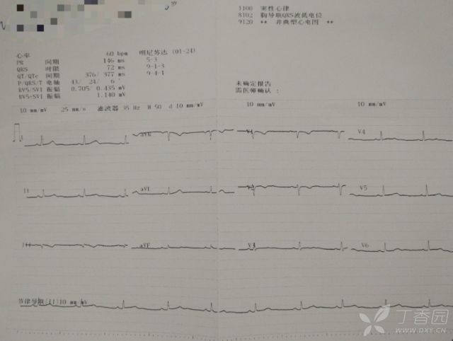 患者口服 300 片地高辛，全程心电图如何演变？