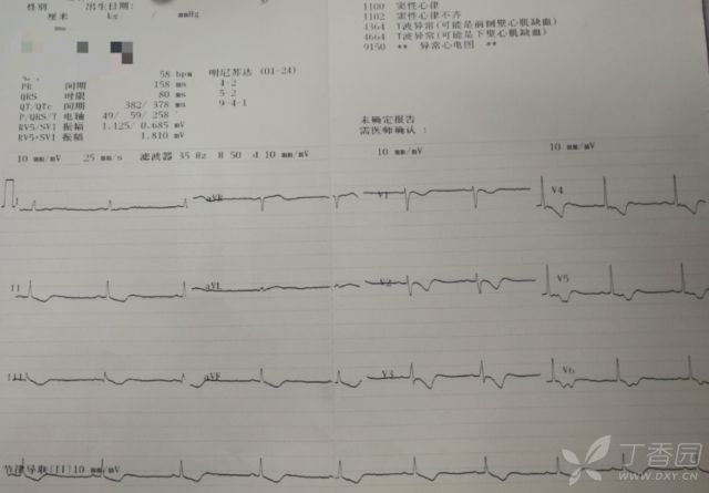 患者口服 300 片地高辛，全程心电图如何演变？