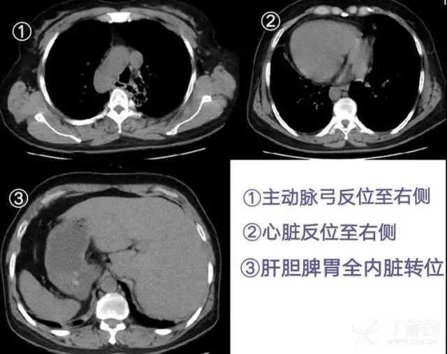 丁香病例 |  「镜面人」遇上罕见病，病情大反转