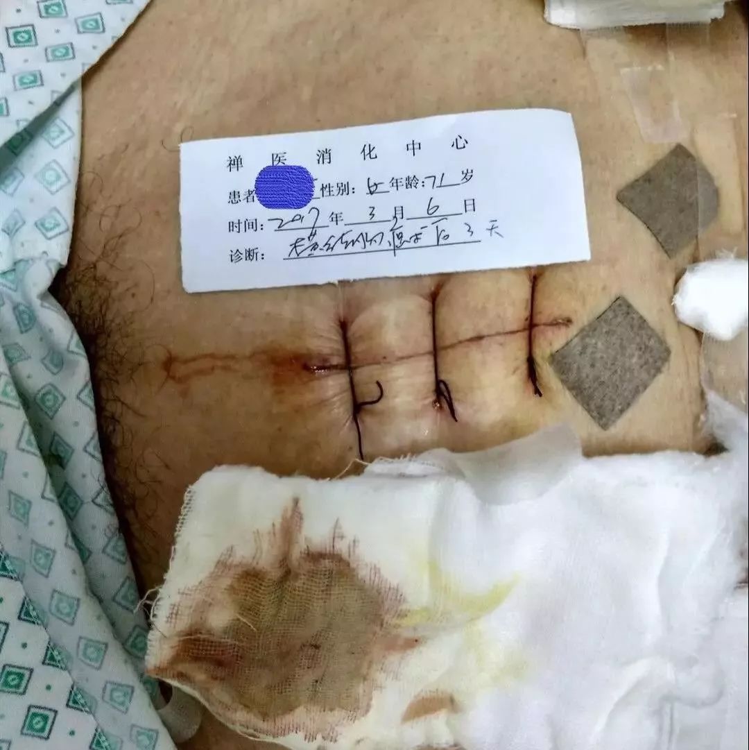 外科医生最怕的切口感染，1 周愈合只需这么做