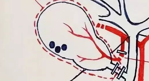还在死磕胆结石手术操作？手绘图教你一秒看明白