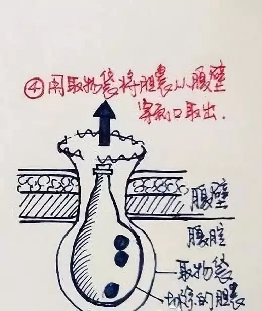 还在死磕胆结石手术操作？手绘图教你一秒看明白