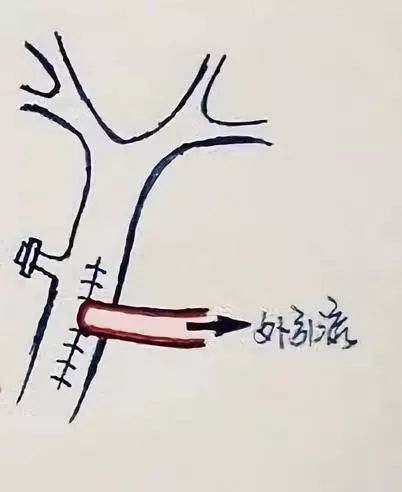 还在死磕胆结石手术操作？手绘图教你一秒看明白