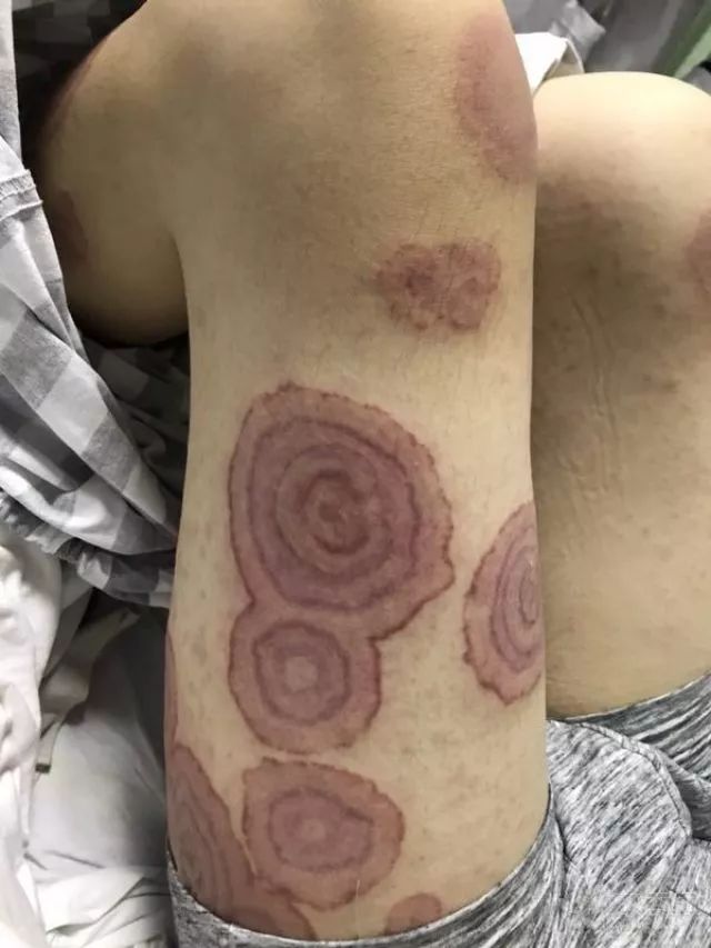 丁香病例 | 腿上长出「年轮」，这是什么病？