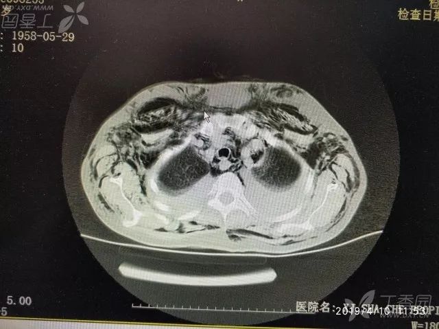 丁香病例 | 难得一见的「充气人」,查完 CT 后死亡 丁香病例 | 难得一见的「充气人」,查完 CT 后死亡