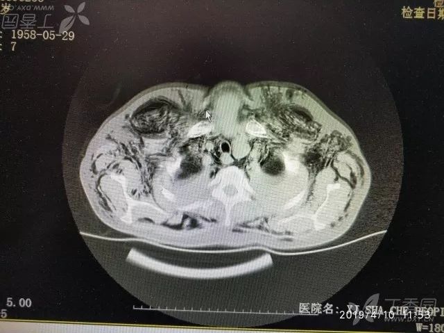 丁香病例 | 难得一见的「充气人」,查完 CT 后死亡 丁香病例 | 难得一见的「充气人」,查完 CT 后死亡