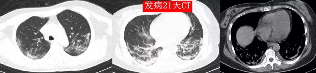 4 次核酸阴性后 CT 确诊，新冠肺炎 CT 表现 5 个特点请牢记