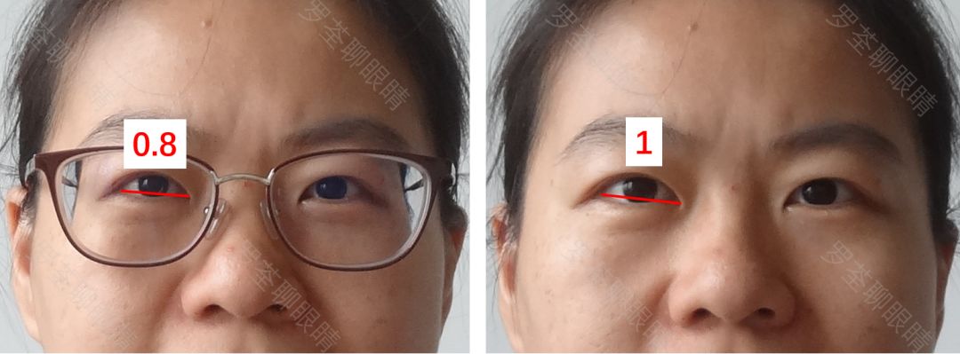 戴近视眼镜后，真的会「变丑」？眼科医生坐不住了