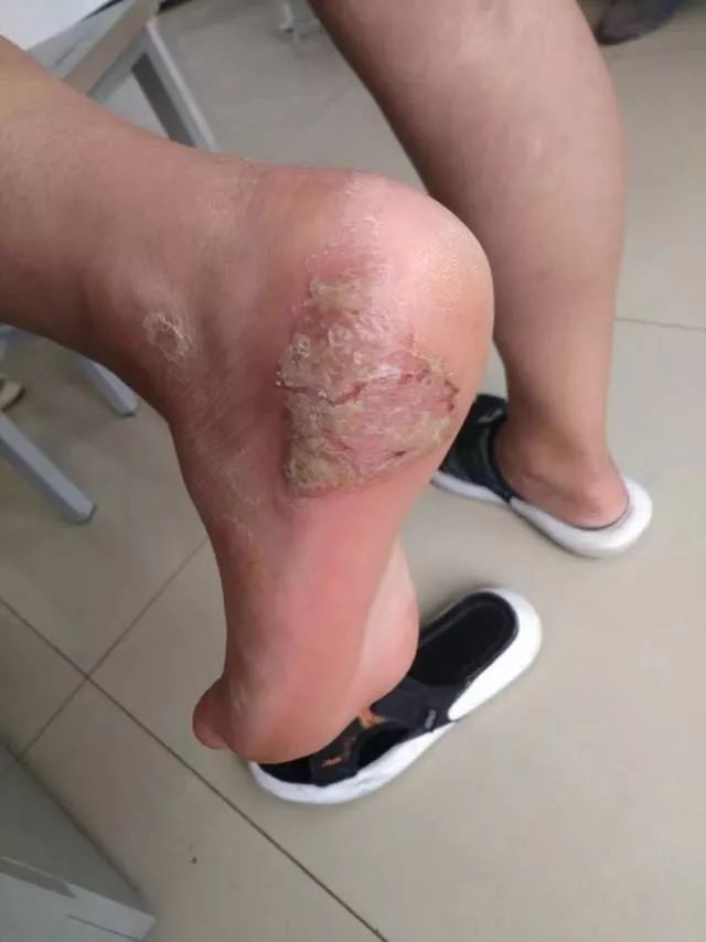 28 岁女子足底红斑久治不愈，追问病史，原因竟然是......
