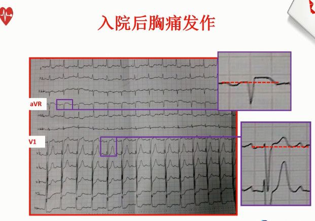 【含病例】告别死记硬背，心电图这样学习不会都难