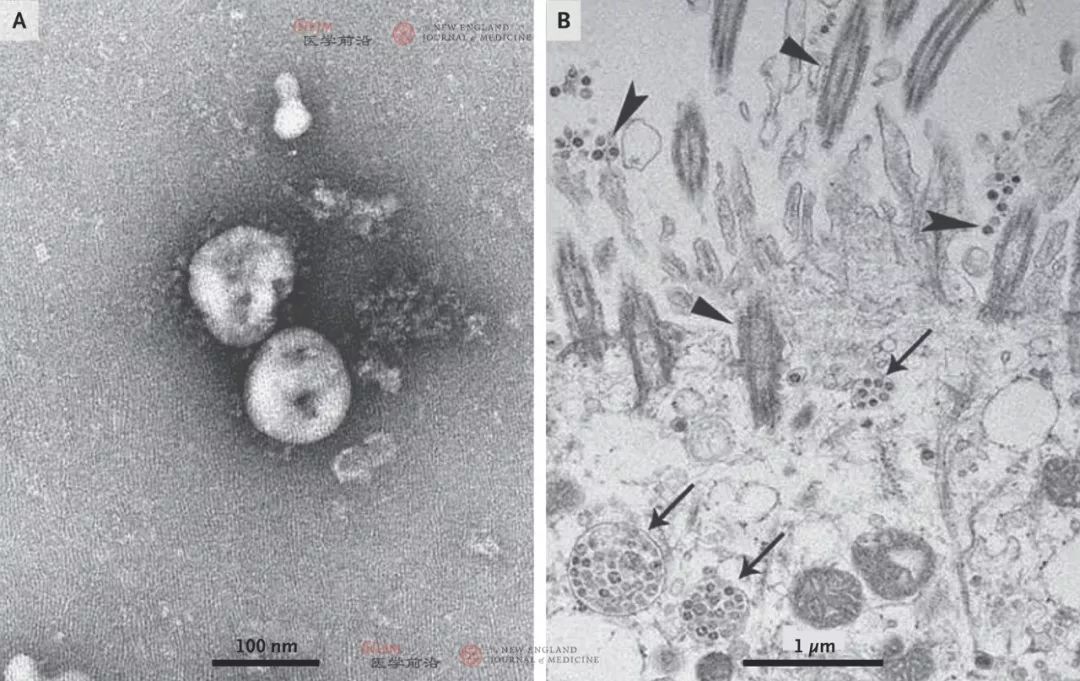 重要数据 | 中国团队在 NEJM 发布新型冠状病毒研究 重要数据 | 中国团队在 NEJM 发布新型冠状病毒研究