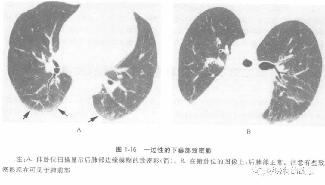 新冠鉴别：双肺疑似毛玻璃影，改变体位结果大不同
