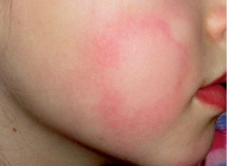 5 类常见儿童荨麻疹，你是否都已掌握？