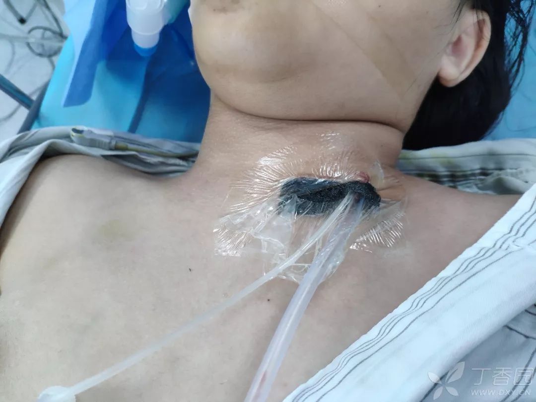 丁香病例 | 咽痛 8 天颈部脓肿，一查原来是「人鱼」女孩
