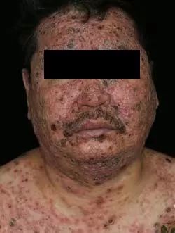 28 岁女子足底红斑久治不愈，追问病史，原因竟然是......