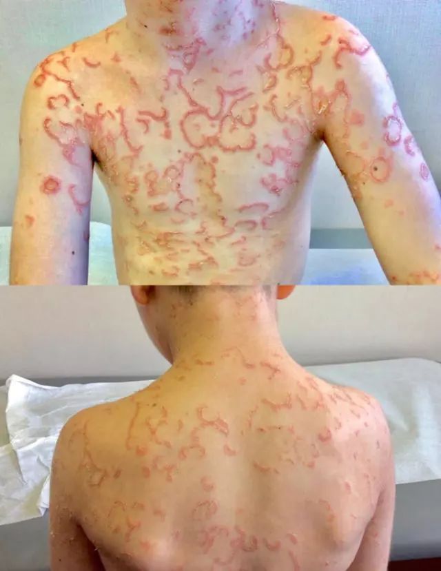 丁香病例 | 男童全身长满「红色鱼鳞」，这个病被误诊了 10 年