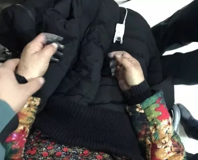 丁香病例 | 三天内手指尖全变黑了，这是什么病？