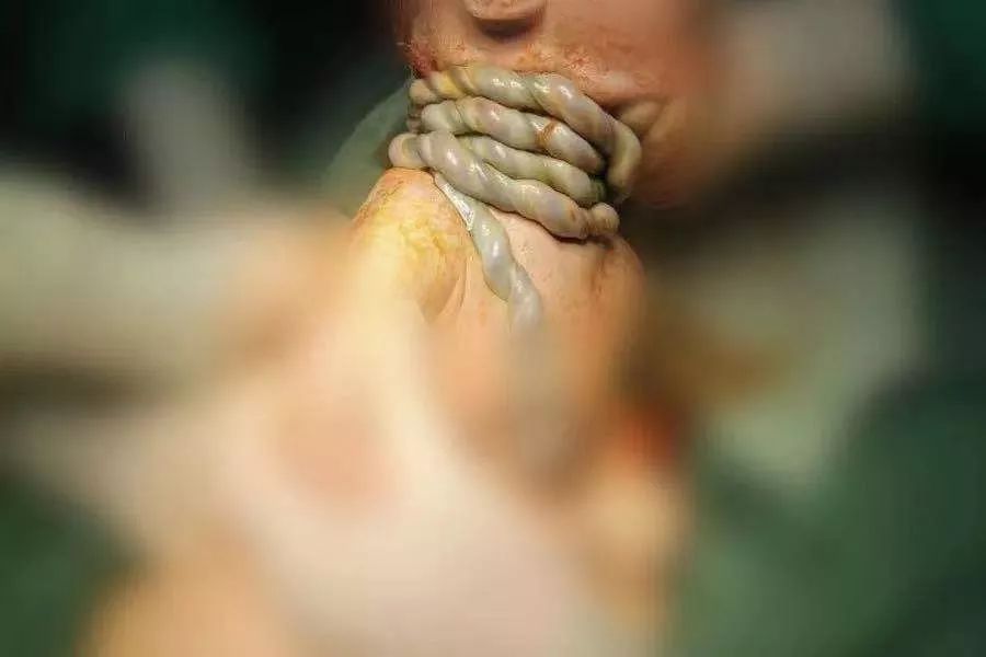 一根脐带杀死 38 周胎儿,而这次不是绕颈…… 一根脐带杀死 38 周胎儿,而这次不是绕颈……