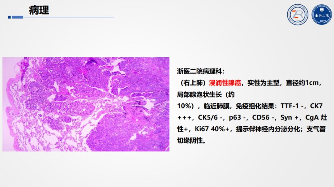 准确判读「肺部结节」，这个要点你一定要掌握