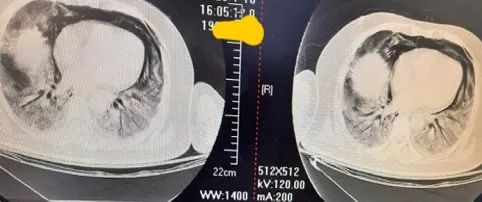 同是重症肺炎，为何 73 岁患者治愈，54 岁患者死亡？